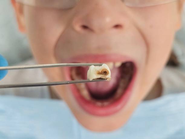 Best Emergency Treatment for Dental Infections or Abscesses in Ringgold, GA